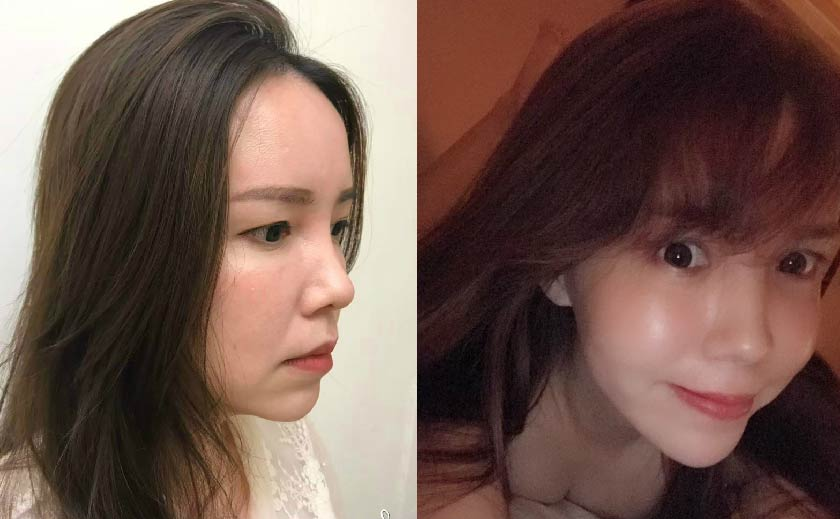 電波拉提真實案例！星和醫美全台皆可預約